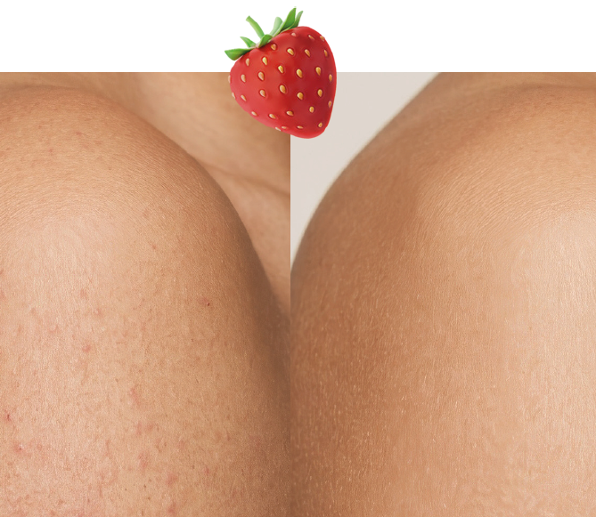 Coudes et genoux rugueux : causes, soins et hyperkératose