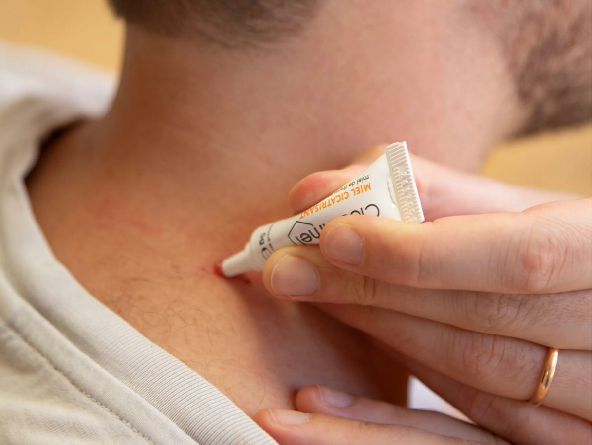 Brûlure de la peau : que faire
