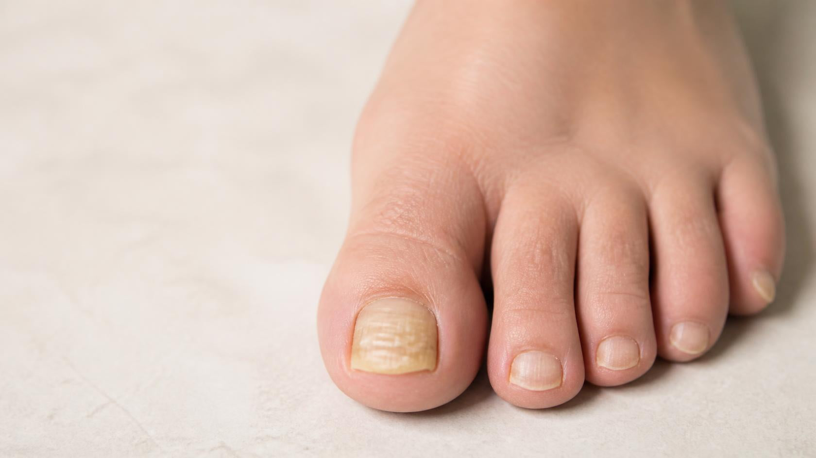 ongle de pied dur et épais