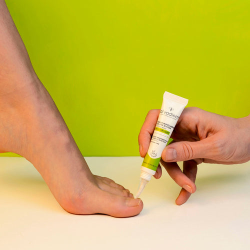 Ongles abîmés par une mycose