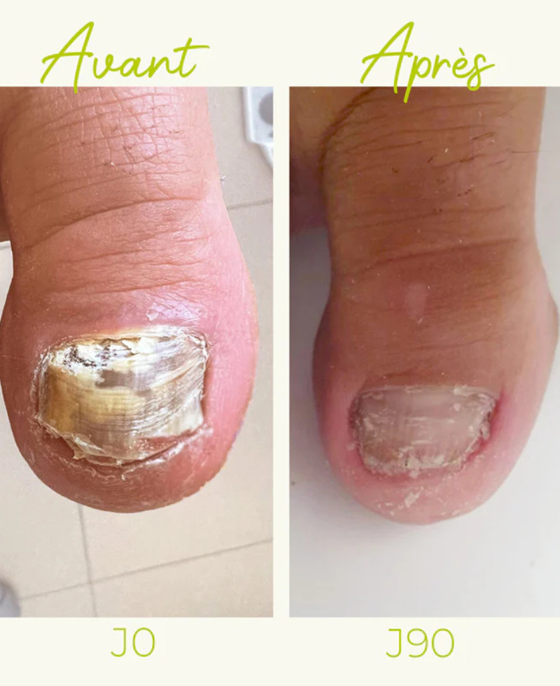 Photo avant après d'une onychomycose, aussi appelé mycose de l'ongle, avec un résultat à 60jours de traitement grâce au Soin Assainissant