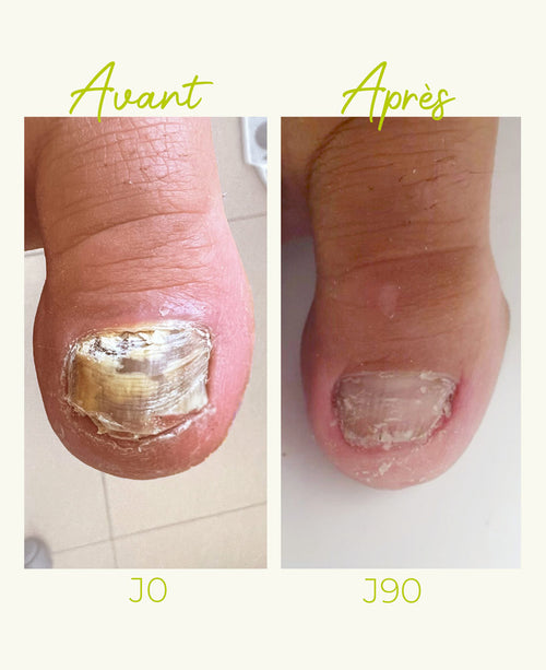 Ongles abîmés par une mycose