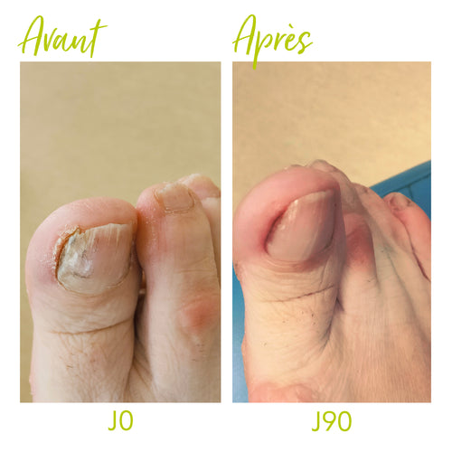 Ongles abîmés par une mycose