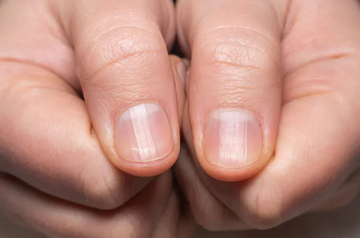 Ongles striés verticalement ou horizontalement