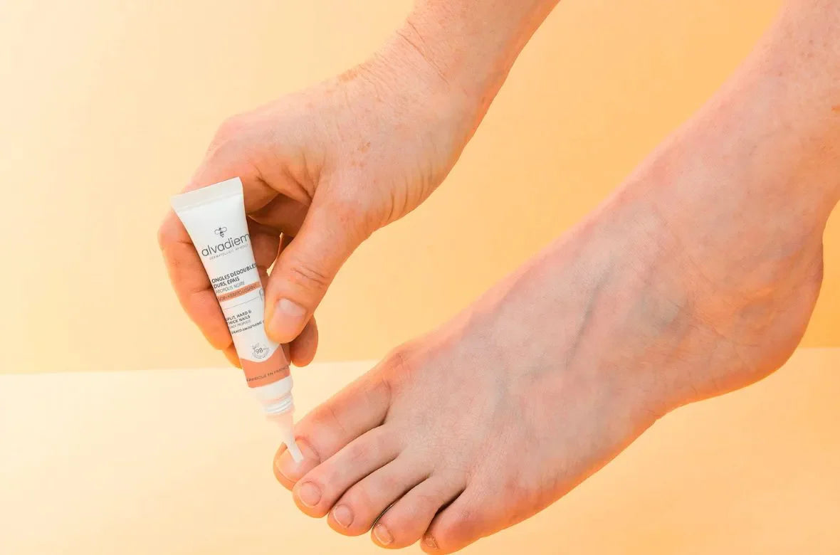 Onycholyse : Les traitements possibles