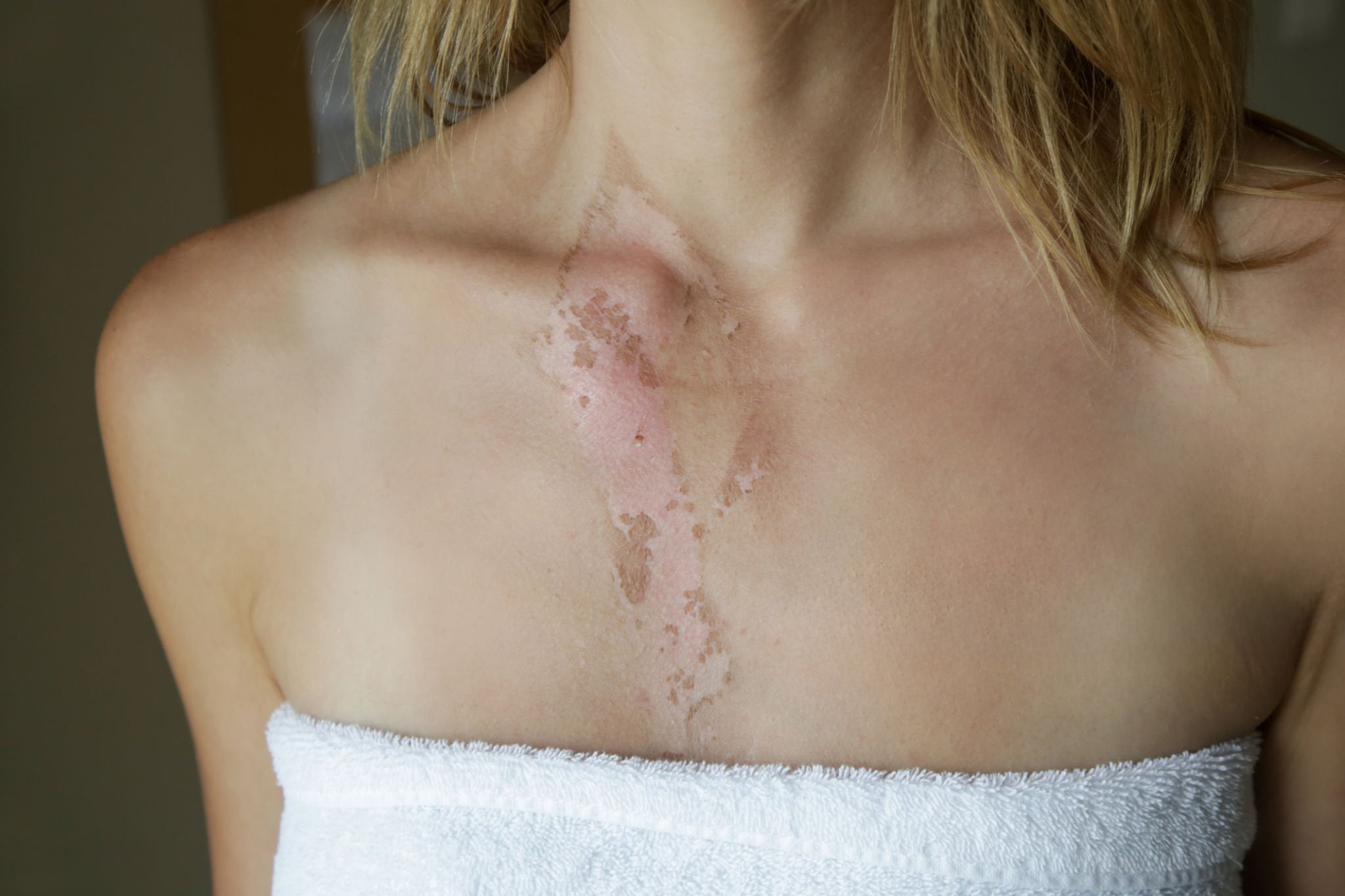 Cloque brulure : causes, prévention, traitements
