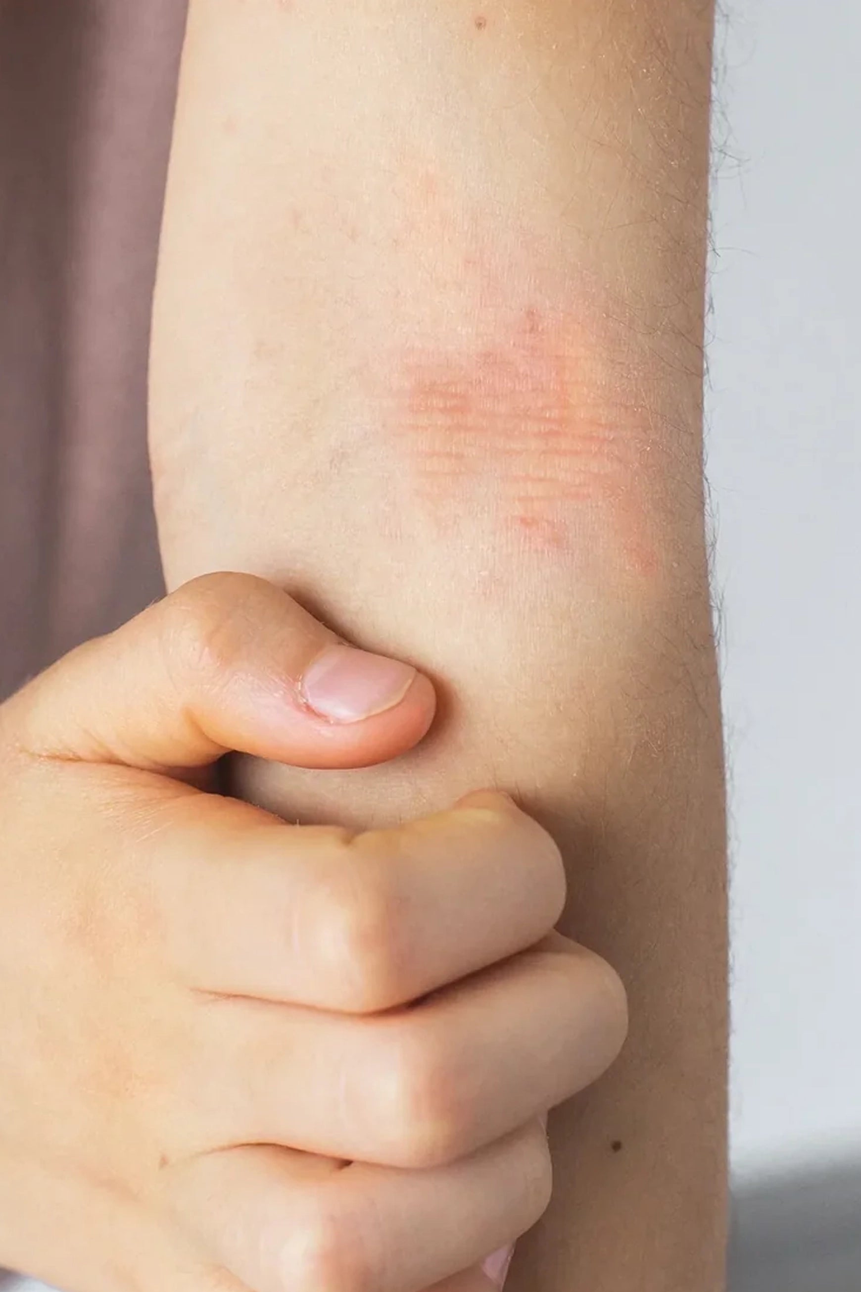 Plaque de sécheresse sur la peau : les bons gestes