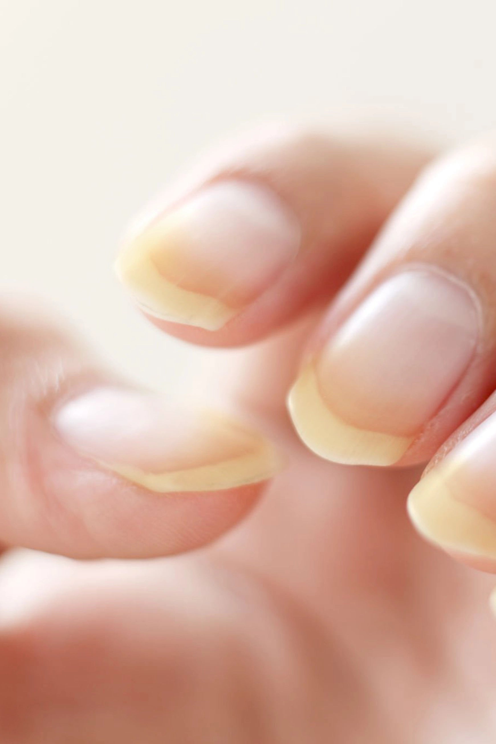 Ongles jaunâtres : causes et traitements