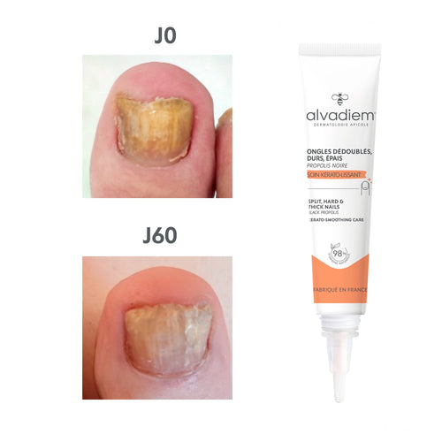 Ongles durs, épais, dédoublés