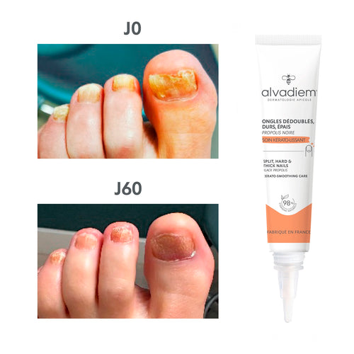 Ongles durs, épais, dédoublés