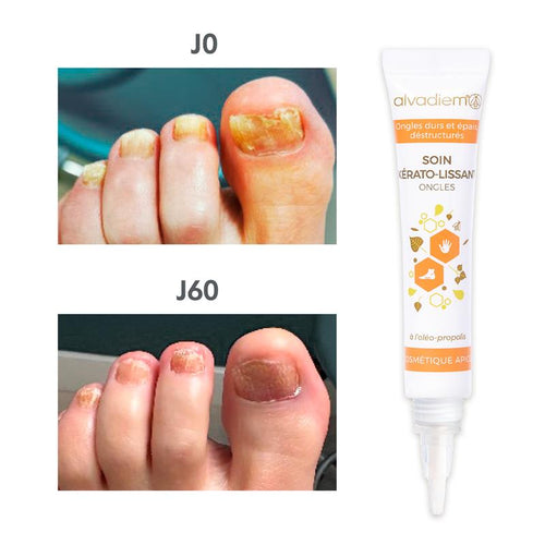 Ongles durs, épais, dédoublés