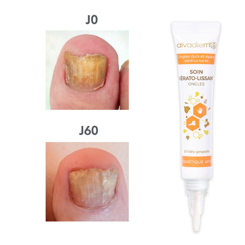 Ongles durs, épais, dédoublés