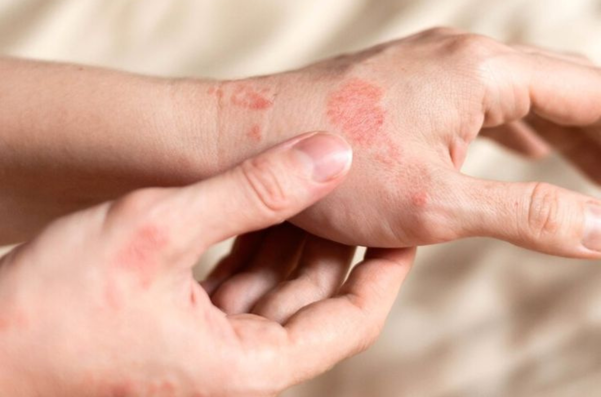 Dartre Sur La Peau Causes Sympt mes Et Traitements Alvadiem Dartre Sur La Peau Causes Sympt mes Et Traitements Alvadiem
