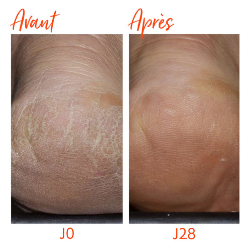 Crème Protectrice Pieds Fragilisés